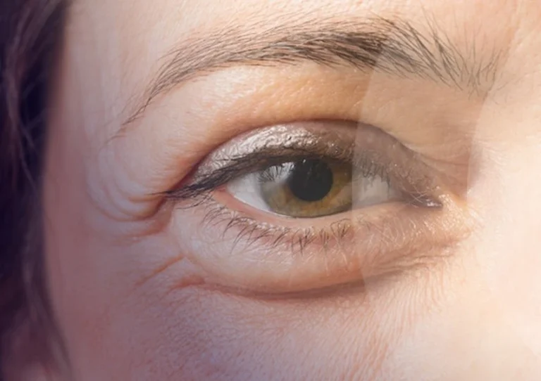 Agnes Göz Altı Torbası Tedavisi Nedir?